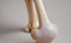 Pseudoartrose: Entendendo a Não União de Fraturas Ósseas